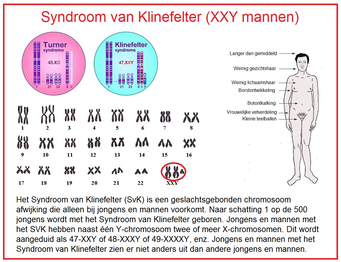 Klinefeltersyndroom