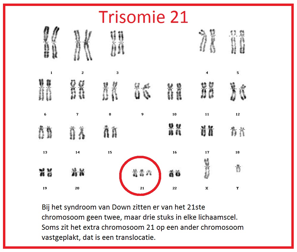 trisomie-21(goede foto)