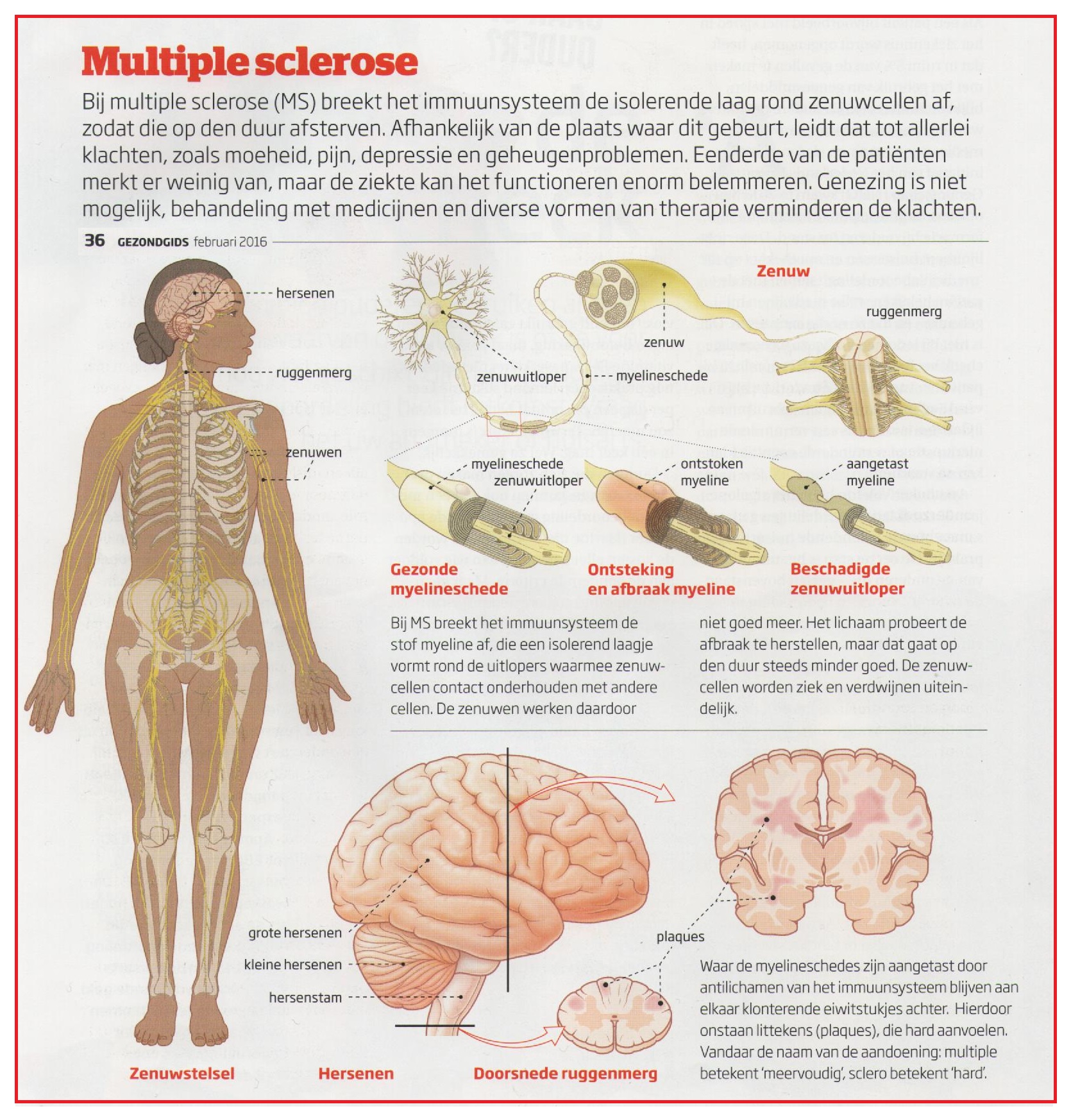 Multiplesclerose2