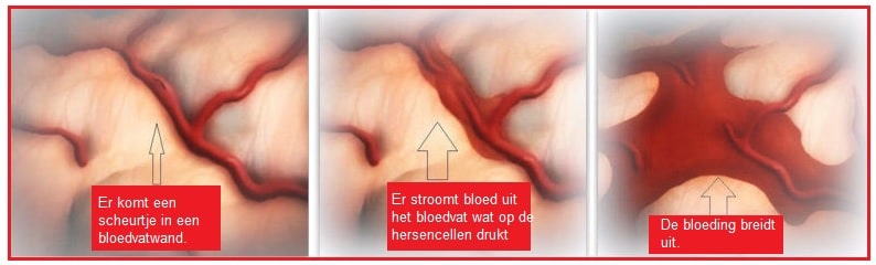 Hersenbloeding