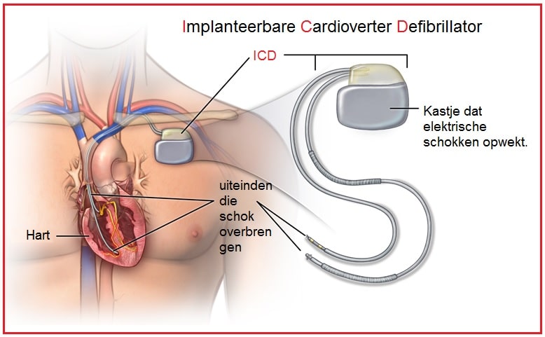 ICD