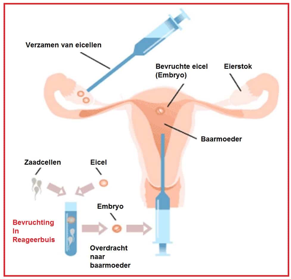 IVF