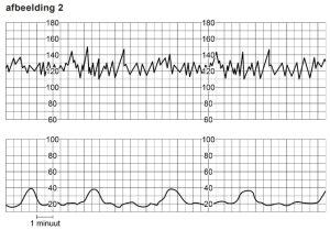 ECG