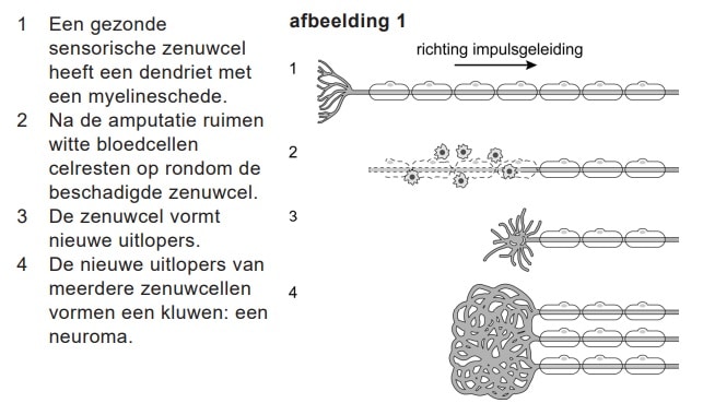 Zenuwpijn