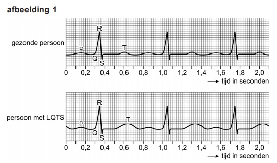 ECG