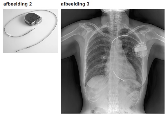 ECG2