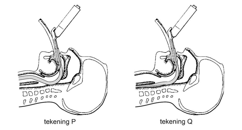 beademing