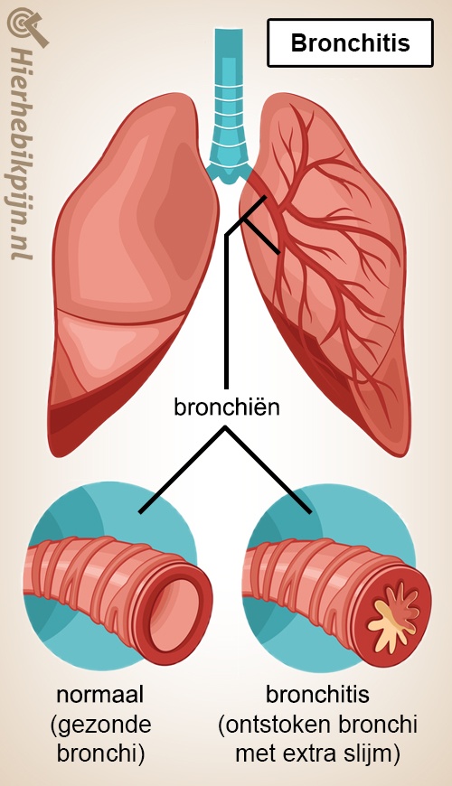 longen bronchitis bronchien normaal gezond ontstoken bronchi slijm vernauwing